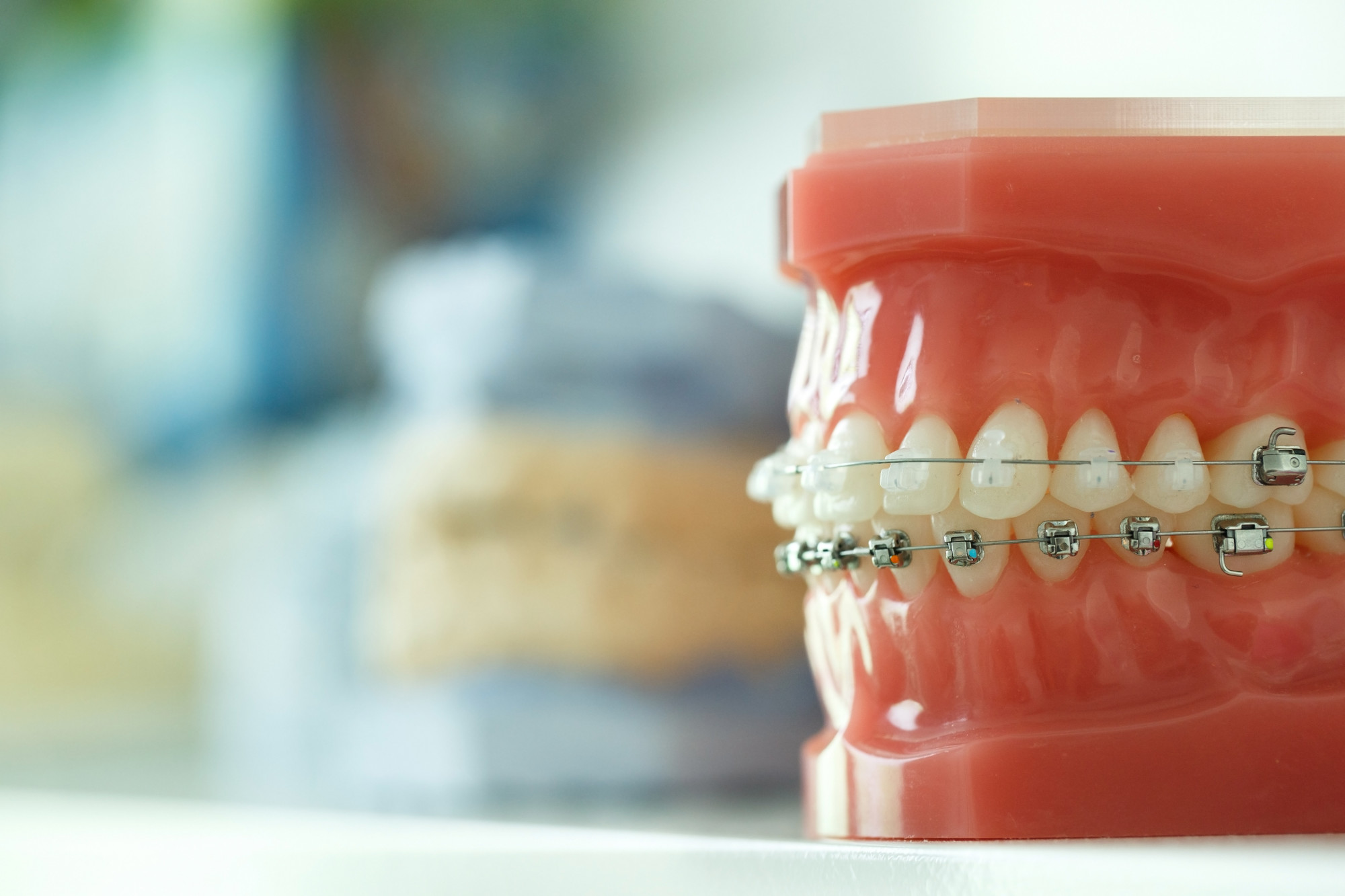 What are the causes of an underbite?